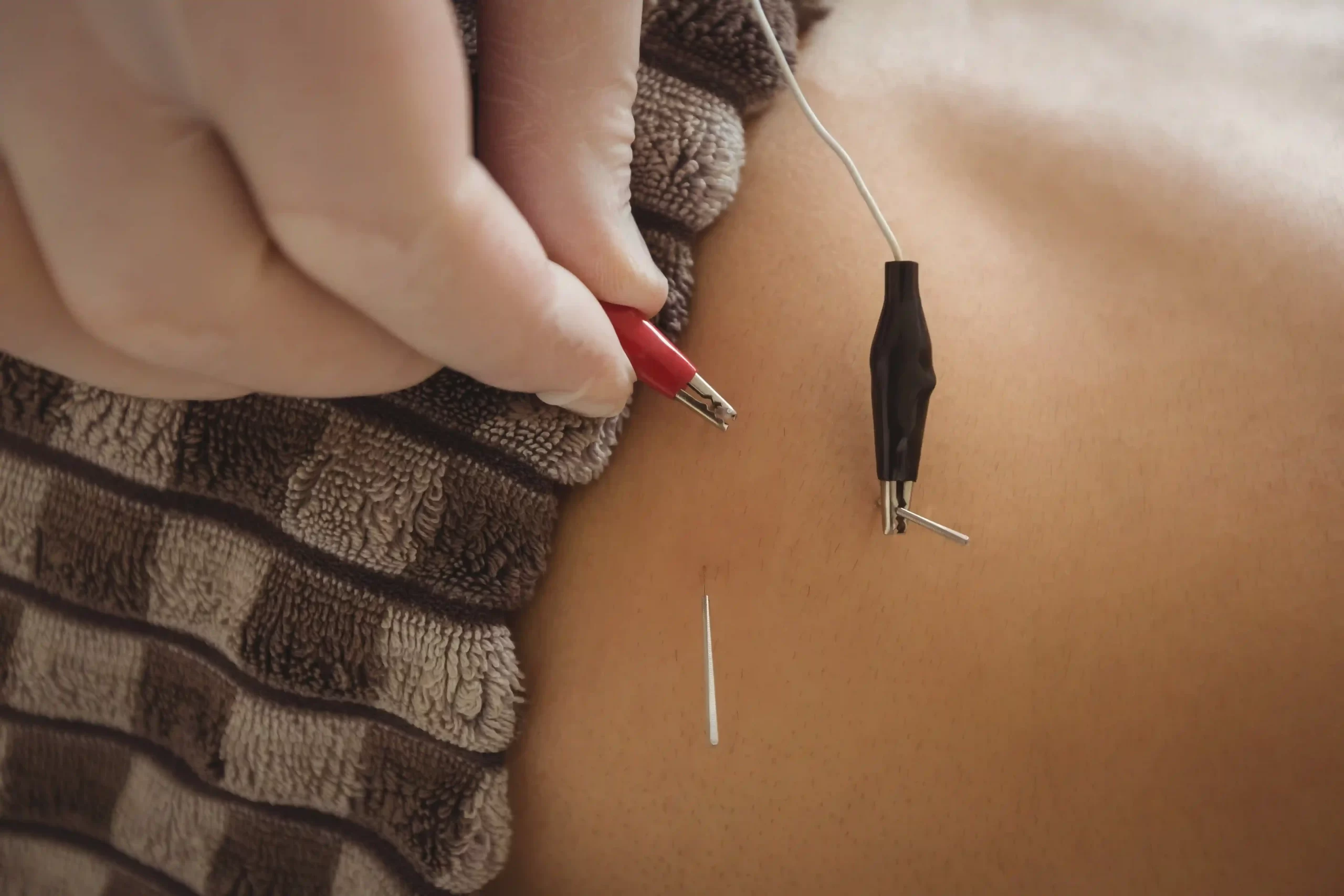 Akupunktur İğnesi Acı Verir mi?